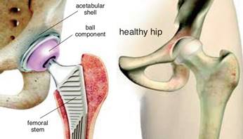 Total Hip Replacement